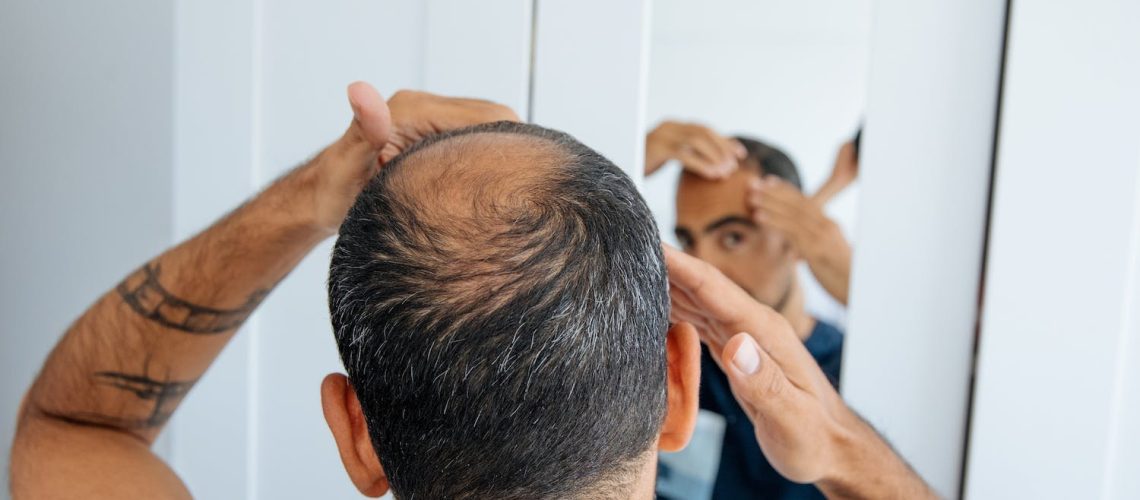 Pourquoi les hommes perdent leurs cheveux ?