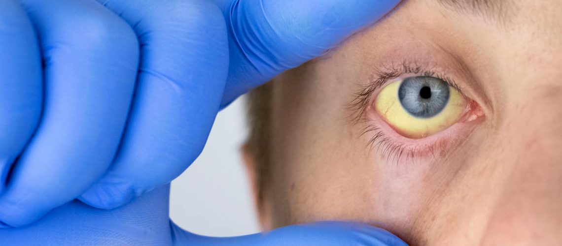 Yeux jaunes : quelles causes ? Quand consulter ?